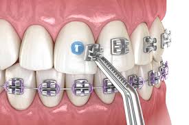 Braket Çeşitleri ve Kullanım Alanları - Alyans Clinic - metal braket