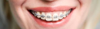 Braket Nedir? Çeşitleri Nelerdir? - Dentakay - metal braket