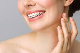 Braket Nedir? Çeşitleri Nelerdir? - Dentaliva - metal braket