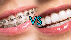 Metal Braketler - Dr. Ahmet Vural - Ortodonti Uzmanı - metal braket