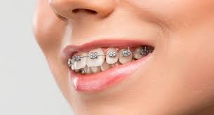 Seramik Braket mi, Safir Braket mi? - Klinik Çayyolu - metal braket