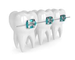5 Types of Braces (Procedures, Costs & FAQs) - NewMouth - metal braket