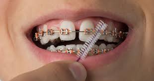 Metal braces: types, cost, and how they work - smile2impress.com - bracket metal